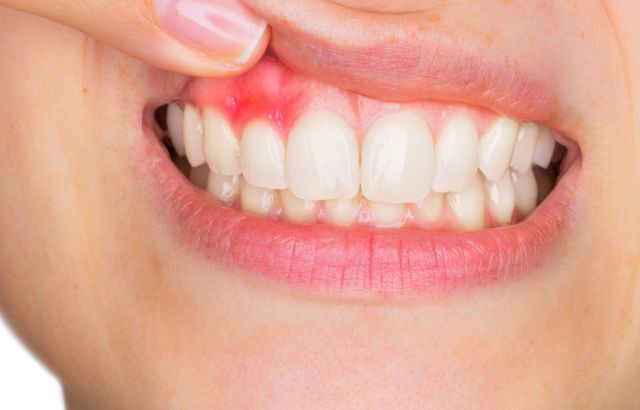 Ontstoken tandvlees gingivitis in mond