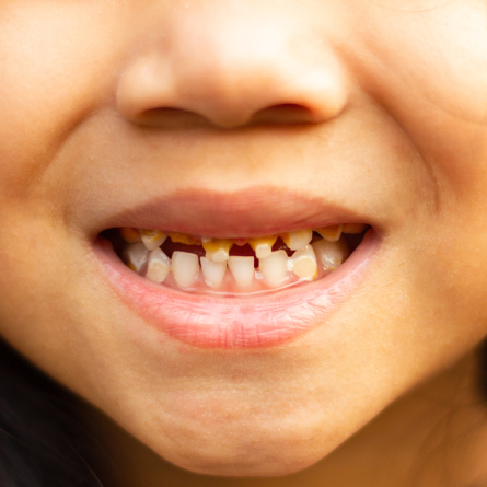 Tips tegen tanderosie om glazuurbeschadiging tegen te gaan